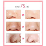 6 Başlıklı Vakumlu Siyah Nokta Temizleyici - Görsel 2