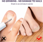 Ayak Tırnağı Düzeltme Bandı 50 Adet - Görsel 3