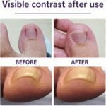 Ayak Tırnağı Düzeltme Bandı 50 Adet - Görsel 4