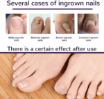 Ayak Tırnağı Düzeltme Bandı 50 Adet - Görsel 5